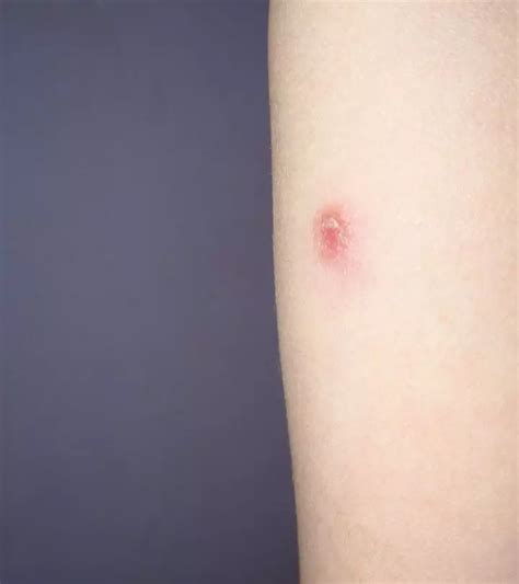 tiny puss|Skin abscess: Pictures, symptoms, causes, and treatment.